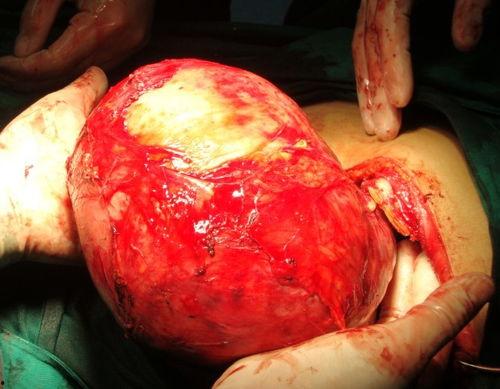 肿瘤的照片,揭示病变特征与病理进程